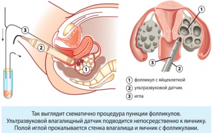 ademioza uterin - ceea ce este simptome și tratament în timpul sarcinii (simptome) ademioza uterin - ceea ce este simptome și tratament în timpul sarcinii