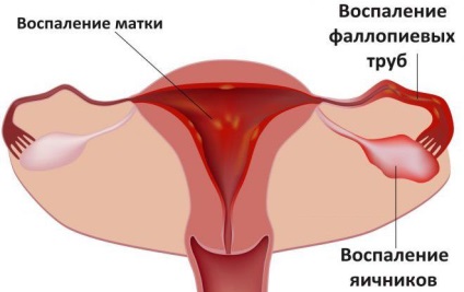 ademioza uterin - ceea ce este simptome și tratament în timpul sarcinii (a) ademioza uterin - ceea ce este simptome și tratament în timpul sarcinii