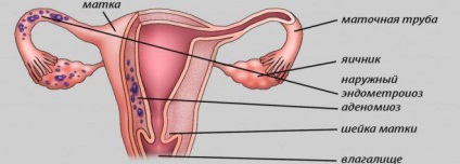 ademioza uterin - ceea ce este simptome și tratament în timpul sarcinii (uter) ademioza uterin - ceea ce este simptome și tratament în timpul sarcinii