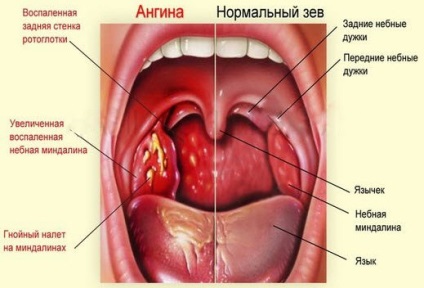 simptome anginoase la adulți și tratament (angină pectorală) Durere în gât la adulți simptome și tratament