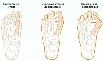 Osteoartrita degetul cel mare în comun (picior) cauze, simptome, tratament, remedii populare (picioare) Osteoartrita degetul cel mare în comun (picior) cauze, simptome, tratament, remedii populare