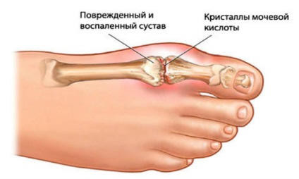 Osteoartrita articulatiei halucelui (picior) cauze, simptome, tratament, remedii populare (mari) Osteoartrita degetul cel mare în comun (picior) cauze, simptome, tratament, remedii populare