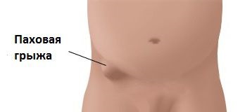 Bandaj pentru inghinale tipuri de hernie și încuietorile funcția (bandaj post-operatorie) Bandaj pentru inghinale tipuri de hernie și încuietori funcția