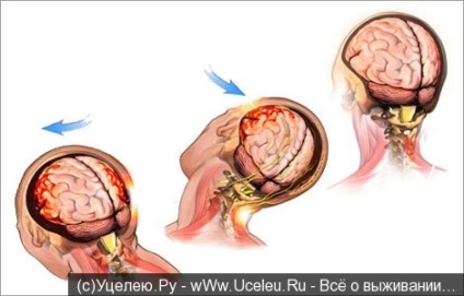 Cele Comoțiile periculoase (leziuni cerebrale) Comotie periculoase