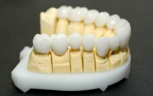 dinte Zirconiu coroană (coroana) coroane dentare Zirconiu