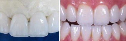Coroana Zirconiu dinte (zirconiu) coroane dentare Zirconiu