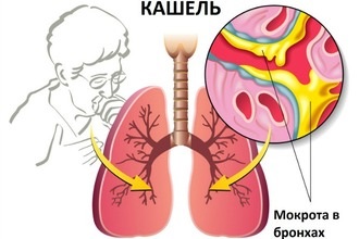 Sinuzita si infectie a sinusurilor - ceea ce este diferența și modul în care acestea diferă (sinuzită) infectie Sinuzita si a sinusurilor - ceea ce este diferența și cum acestea diferă