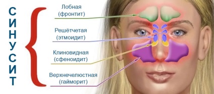 Sinuzita si infectie a sinusurilor - ceea ce este diferența și modul în care acestea diferă (sinuzită) infectie Sinuzita si a sinusurilor - ceea ce este diferența și cum acestea diferă