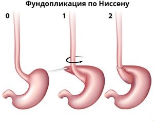Tratamentul chirurgical al GERD, descrierea metodelor de operații (metode) Tratamentul chirurgical al GERD, o descriere a unei metode