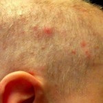 Herpes pe cap fotografie, simptome, cauze, tratament (simptome) Herpes pe cap fotografie, simptome, cauze, tratament