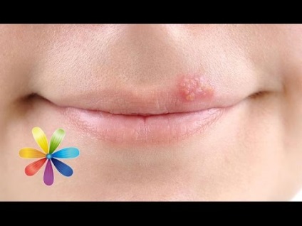 tratament Herpes culoare, simptome si cauze de par (tratament) Herpes tratament de culoare, simptome si cauze de păr