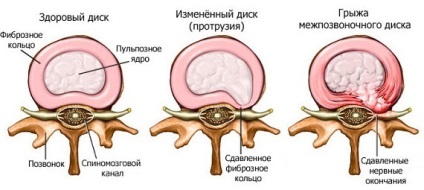 Yoga în hernie spinării (hernie de yoga lombară a coloanei vertebrale sacrale intervertebral proeminenței osteocondrozei tratament scolioză de col uterin) Yoga în hernie spinării