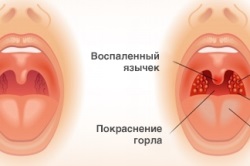 Cum de a trata angina pectorala si metode de prevenire (tratate) Cum de a trata metodele de prevenire și de angină pectorală