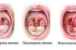 Cum de a trata metode de prevenire a anginei și (metode de tratare a anginei) Cum de a trata metodele de prevenire și de angină pectorală