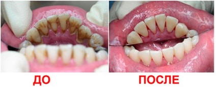 Distingându de carii dentare calcul, placi si pigmentare (placi) Cum se distinge descompunerea tartru, placa si pigmentare