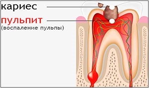 Distingându de carii dentare calcul, placi si pigmentare (dentare) Cum se distinge descompunerea tartru, placa si pigmentare