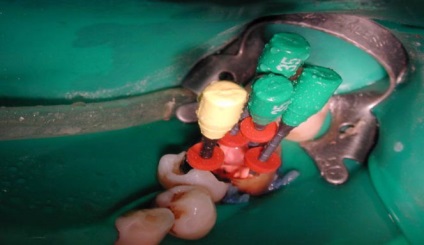 Cum de a recupera dinte aproape complet distruse (restabilirea) Cum de a recupera dinte aproape complet distruse