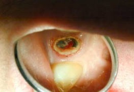 Cum de a recupera dinte aproape complet distruse (distruse) Cum de a recupera dinte aproape complet distruse