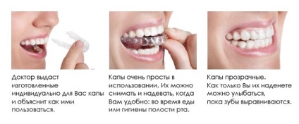 Capa pentru alinierea dinților și corectarea ocluziei (dinți) gutiera pentru alinierea dintilor si corectarea mușcătură