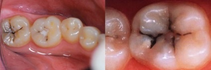 Cariile sub un sigiliu și o imagine a lui (carie de umplere depulpirovat coroanei dentare secundar) Cariile sub sigiliu și fotografii