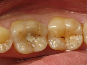 Cariile sub un sigiliu și o imagine a lui (carie de umplere depulpirovat coroanei dentare secundar) Cariile sub sigiliu și fotografii