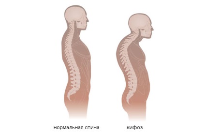 Cifoză a coloanei vertebrale lombare (a coloanei vertebrale lombare) Cifoză a coloanei vertebrale lombare