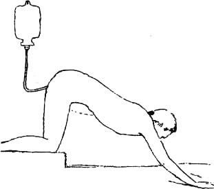 promyvanie- irigare colonic (Lena) (curățirea colonului) irigare promyvanie- colonic (Lena)
