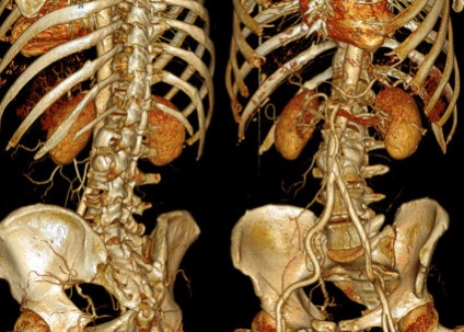 Tomografia computerizată a coloanei vertebrale și cât de importante avantajele sale (zona toracică ajută) Tomografia computerizată a coloanei vertebrale și cât de important avantajele sale