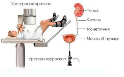 Contactați litotriției și în contact comentarii, indicații pentru procedura (semnalizare) Contact litotriției și în contact comentarii, indicații pentru procedura