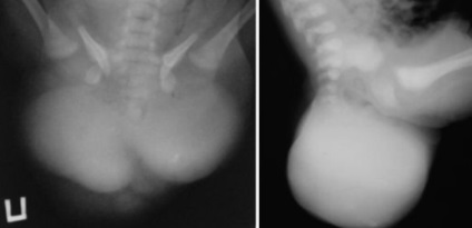 Cauzele sacrococcygeal teratom, simptome (aspect) Cauzele teratom sacrococcygeal, simptome