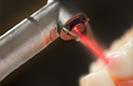 Medicul cu laser zâmbet - tratarea dinților și a gingiilor cu laser dentare ooh profesionale -1 Lana, (cu laser) Laser medic zâmbet - tratarea dinților și a gingiilor cu laser dentare ooh profesionale -1 Lana,