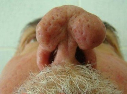 Tratamentul Rhinophyma și profilaxia (prevenirea rhinophyma) Tratamentul și prevenirea rhinophyma