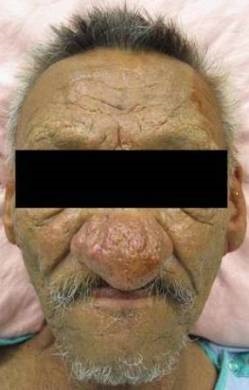 tratament și profilaxie Rhinophyma (prevenire) Tratamentul și prevenirea rhinophyma