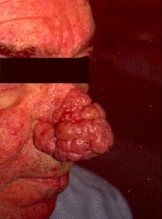 tratamentul si prevenirea Rhinophyma (tratament) Tratamentul și prevenirea rhinophyma