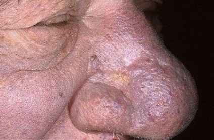 Tratamentul și prevenirea rhinophyma (rhinophyma) Tratamentul și prevenirea rhinophyma