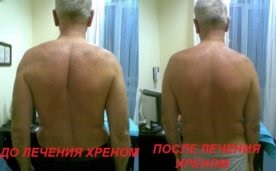 Hrean frunze cu contraindicații osteohondroză, comentarii video (hrean) Hrean frunze cu contraindicatii osteohondroză, video, comentarii