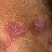 Unguent lichen planus (plat) lichen plan Unguent