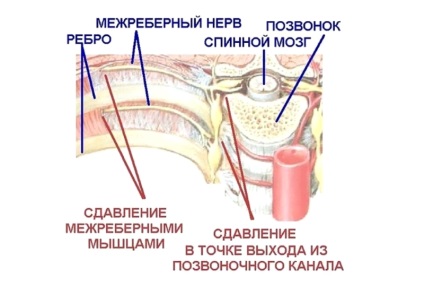 Intercostal nevralgii, simptome și tratament (tratament) nevralgie intercostală, simptome și tratament