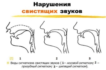 tipuri interdentare șopotitor sâsâit și corecție (corecție) tipuri interdentare șopotitor sâsâit și corectarea