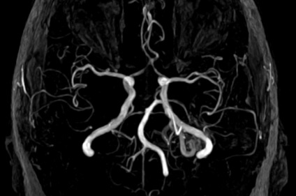 Tratamentul microchirurgical al bolilor vasculare cerebrale (creier) Tratamentul microchirurgical al bolilor cerebrovasculare