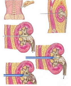 Urolitiaza (simptome pietre la rinichi) urolitiaza