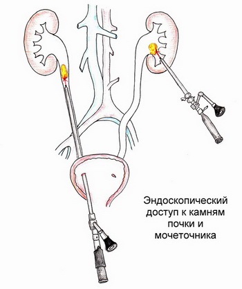 Urolitiaza (piatra in ureter) urolitiaza