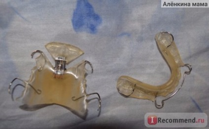 plăci ortodontice pe dinti pentru a corecta mușcătură la copii (ortodontic) plăci ortodontice pe dinti pentru a corecta muscatura la copii