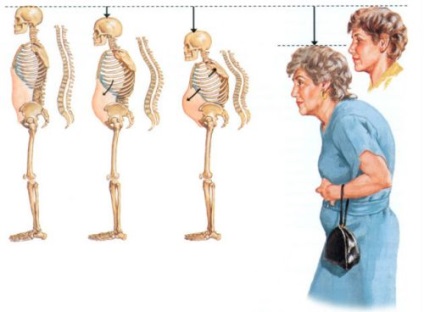 Grad 4 Osteoporoza tratament, simptomele și consecințele (simptome) Osteoporoza grad 4 de tratament, simptomele și consecințele