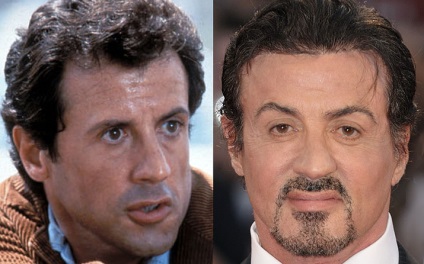 Plastic Sylvester Stallone (Sylvester Stallone chirurgie plastica) Plastic Sylvester Stallone