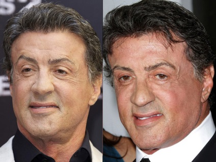 Plastic Sylvester Stallone (Sylvester Stallone fotografie înainte și după) Plastic Sylvester Stallone