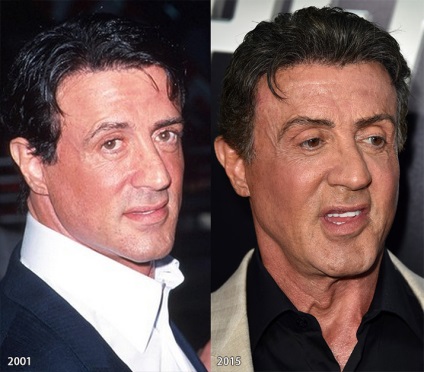 Plastic Sylvester Stallone (Sylvester Stallone chirurgie plastica) Plastic Sylvester Stallone