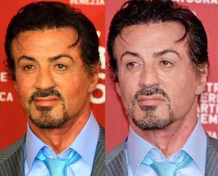 Plastic Sylvester Stallone (Sylvester Stallone chirurgie plastica) Plastic Sylvester Stallone