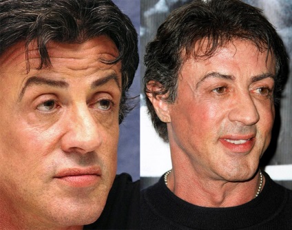 Plastic Sylvester Stallone (Sylvester Stallone de transplant de par) Plastic Sylvester Stallone