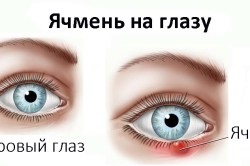 De ce doare pleoape (ochi sănătoși) De ce doare pleoapele